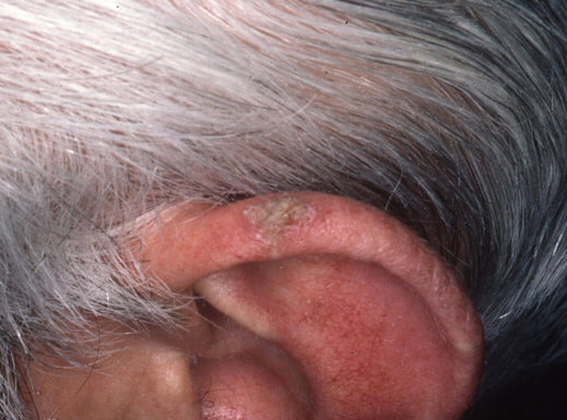 Lesione ipercheratosica sull'orecchio sinistro