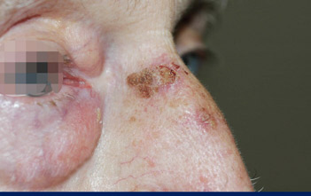 Lesione ulcerata da cheratosi attinica