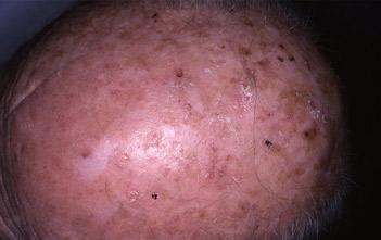 campo di cancerizzazione sul cuoio capelluto